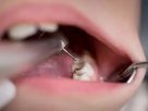 cáries dentárias