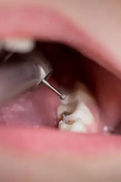cáries dentárias