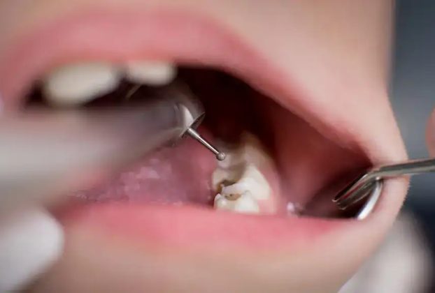 cáries dentárias