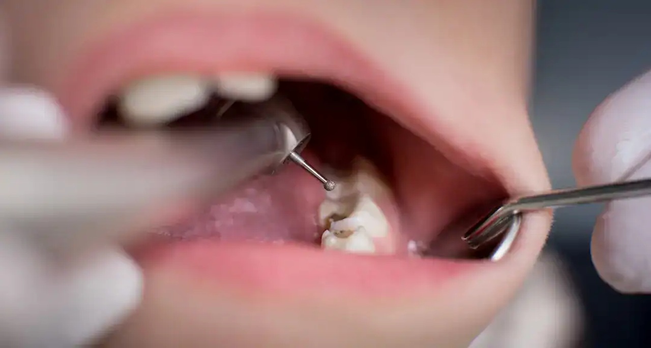 cáries dentárias