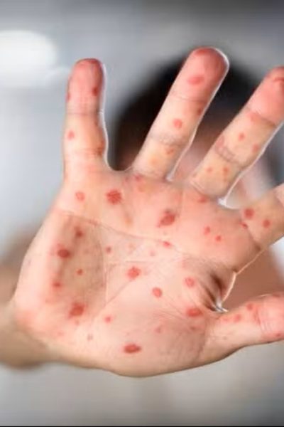 Mão com erupções cutâneas avermelhadas, típicas do sarampo.