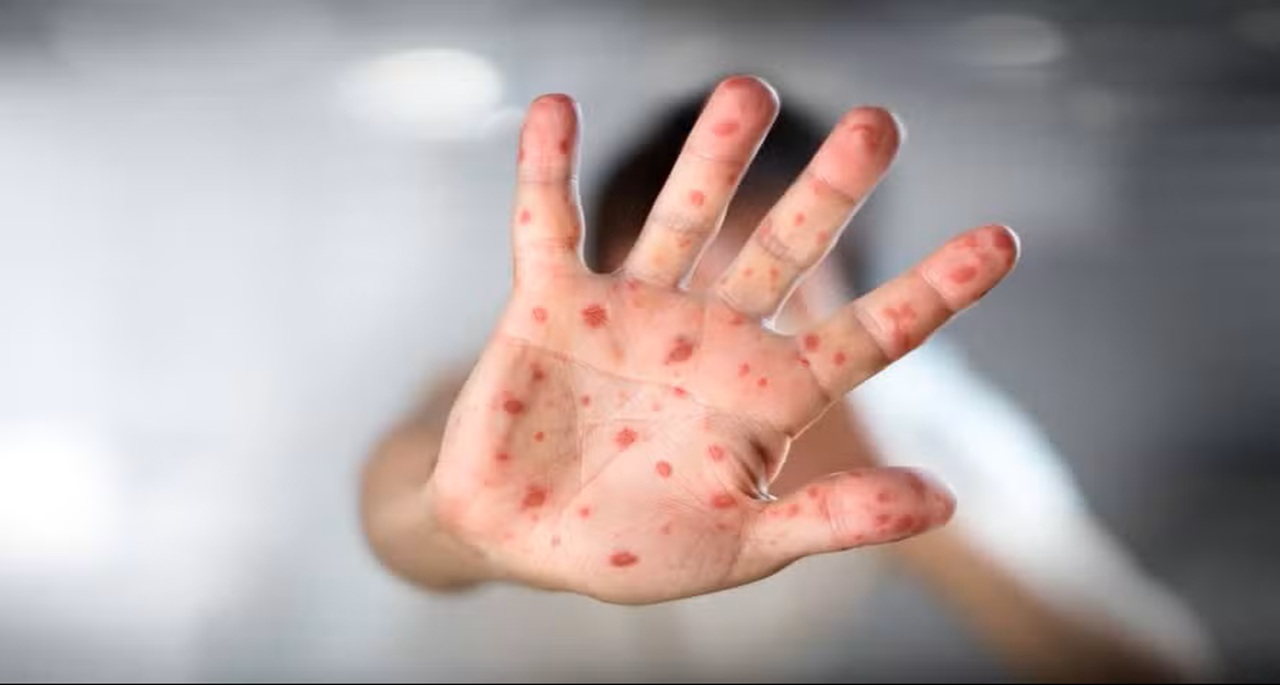 Mão com erupções cutâneas avermelhadas, típicas do sarampo.